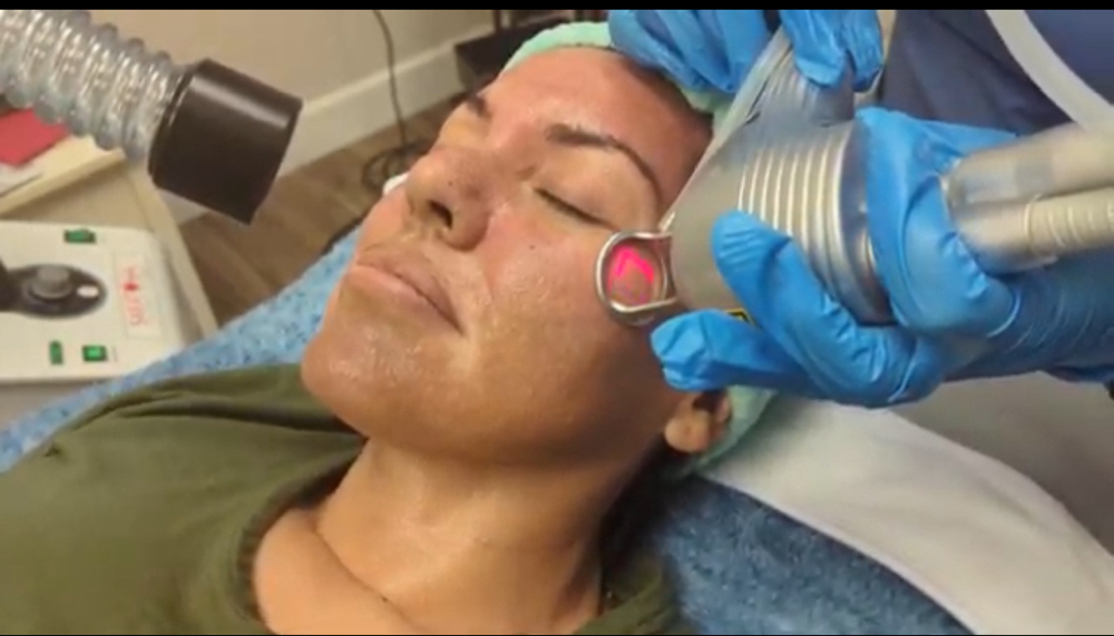 Laser Skin Resurfacing