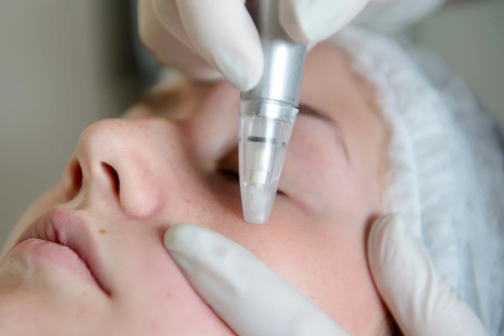 Microdermabrasion With Peel