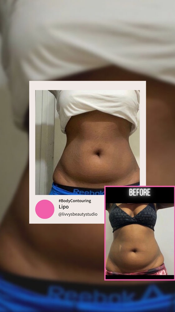 I-Lipo