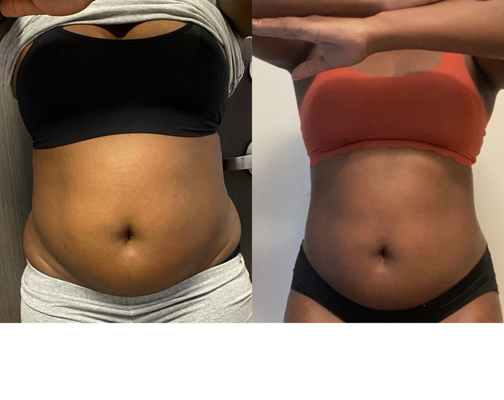 Lipo Cavitation