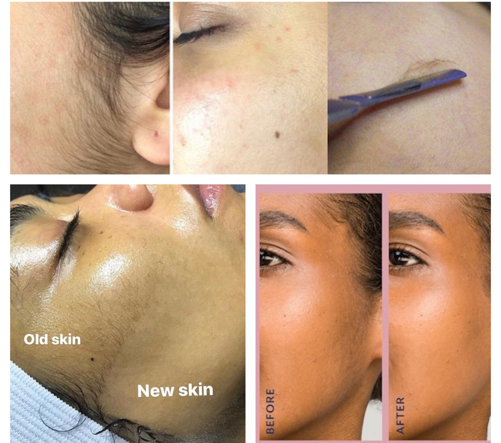 Dermaplaning