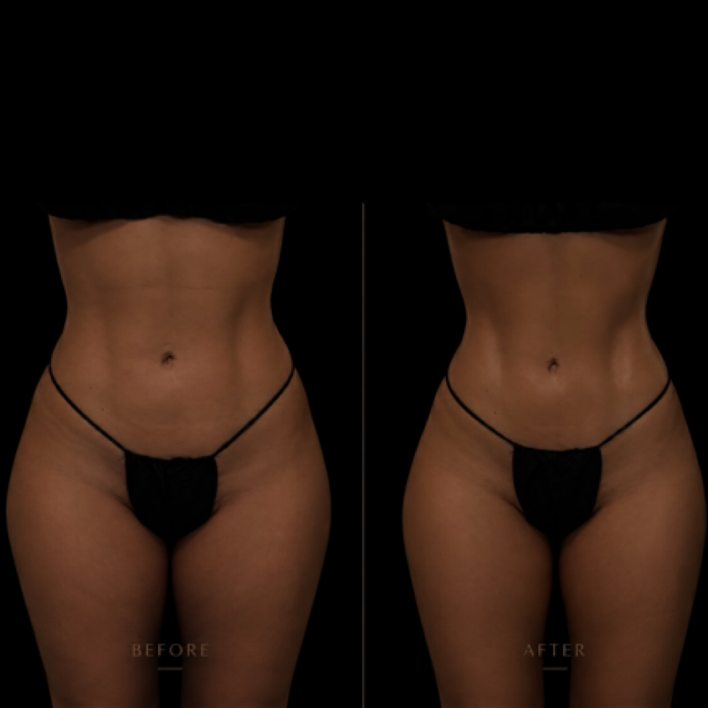 Brazilian Lymphatic Drainage at Vida Wellness in San Diego, CA