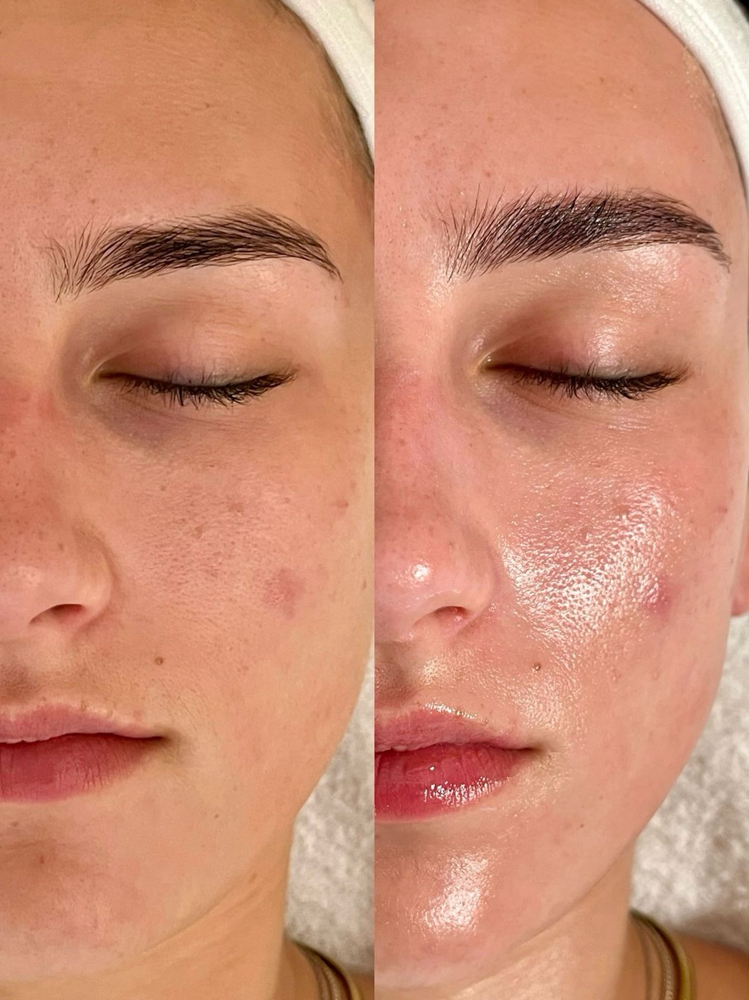 Winter Chemical Peel Facial at Studio Glow Esthetics By Ashten in Coshocton, OH