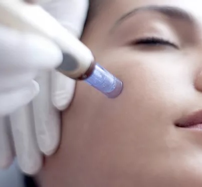 MicroNeedling Facial