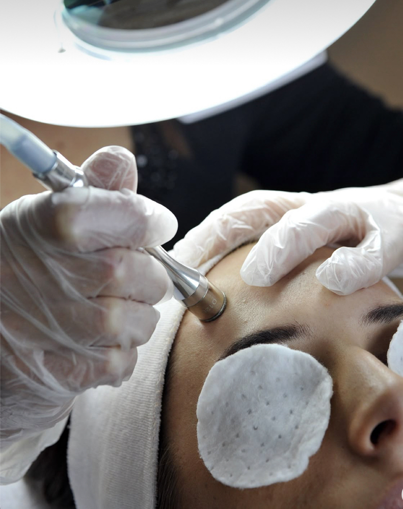 Microdermabrasion Treatment
