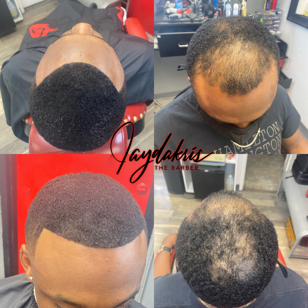Hairline / Bald Spot Repair