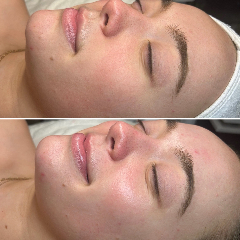 Teen Clear Skin Facial at Esthetics By Merissa in Canby, OR