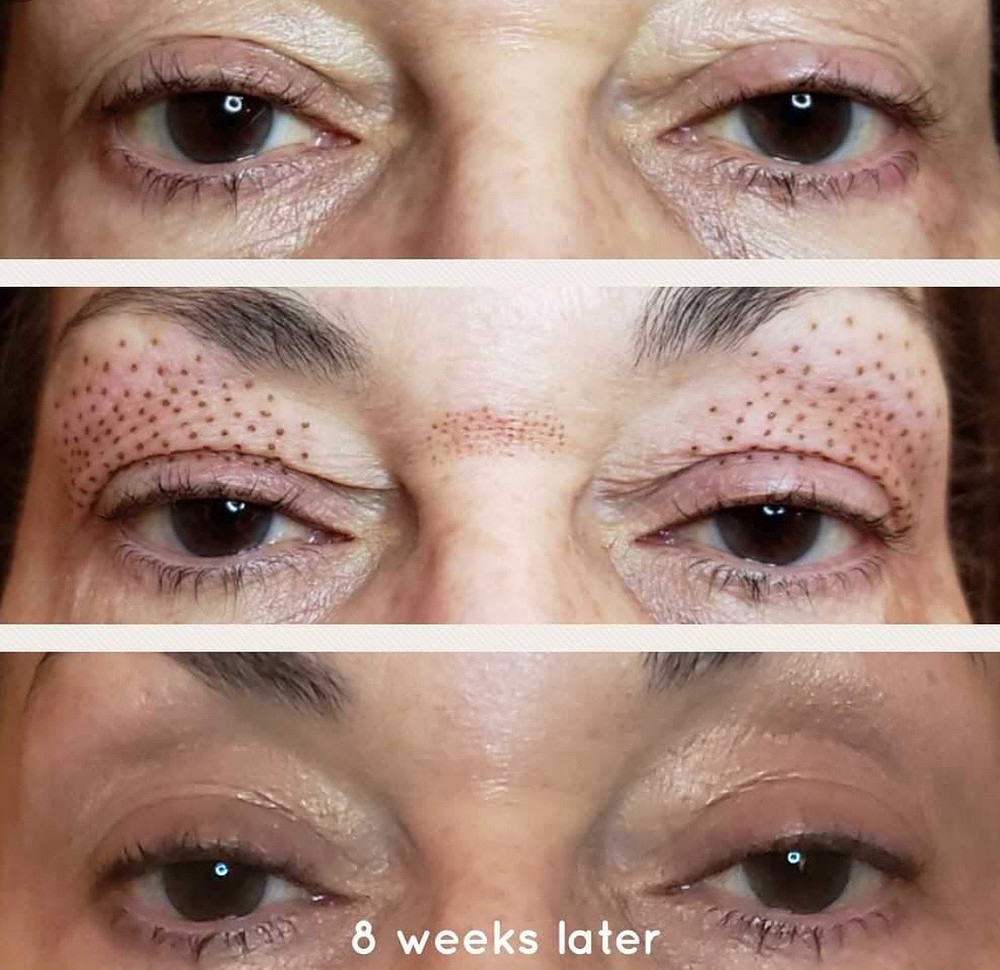 Plasma Fibroblast Upper Eyelids