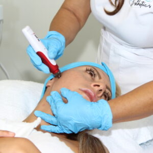 Microneedling