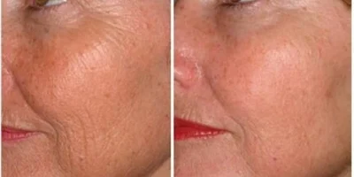 Microneedling