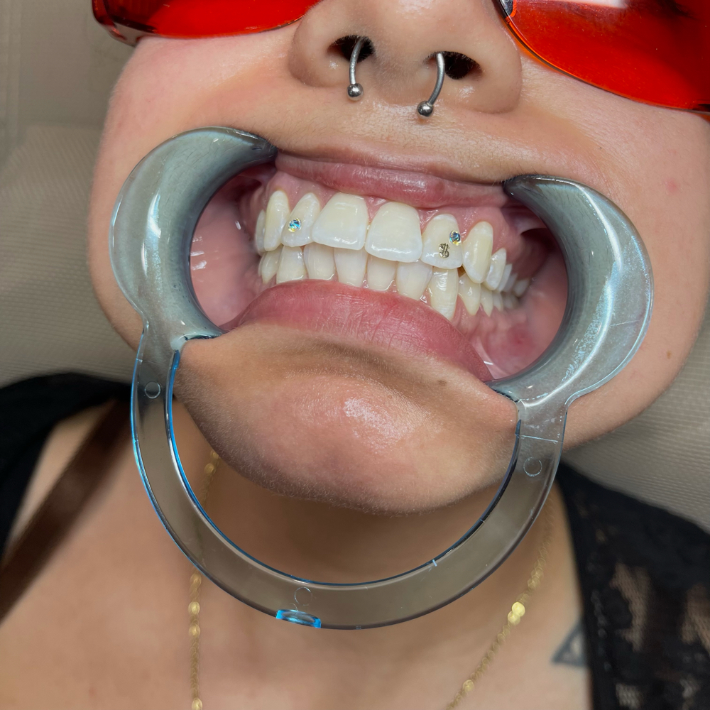 Tooth Gem