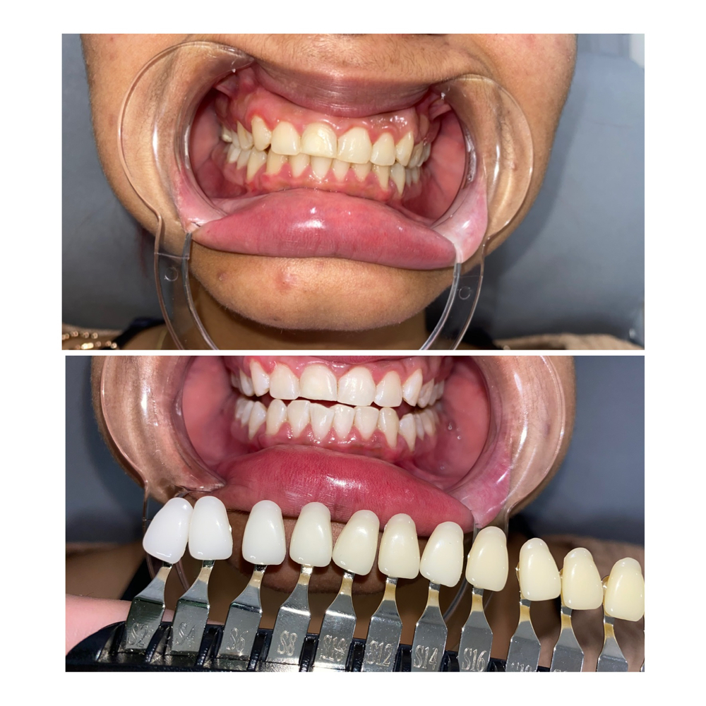 Tooth Whitening