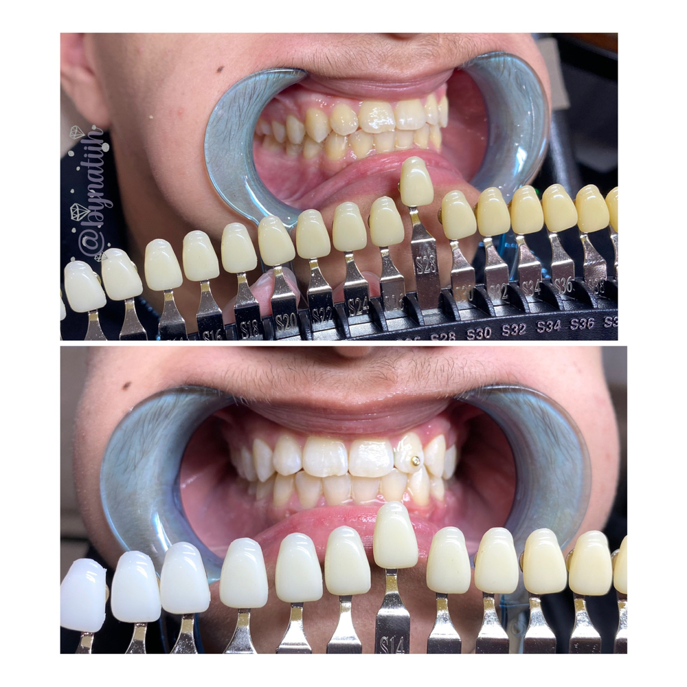 Tooth Whitening