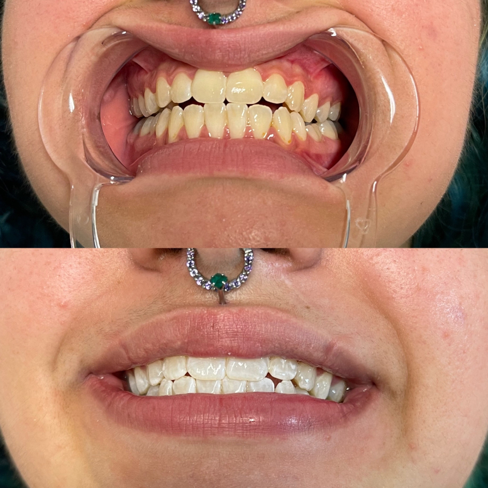 Teeth Whitening Session - 60 Min