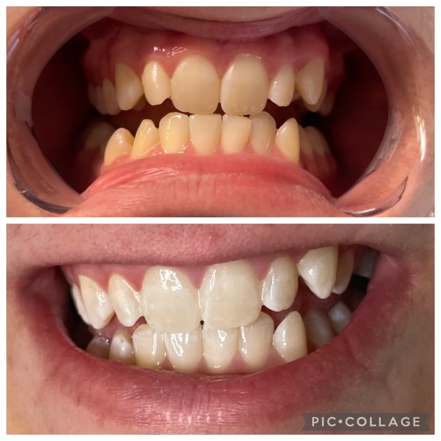 Teeth Whitening Session - 40 Min