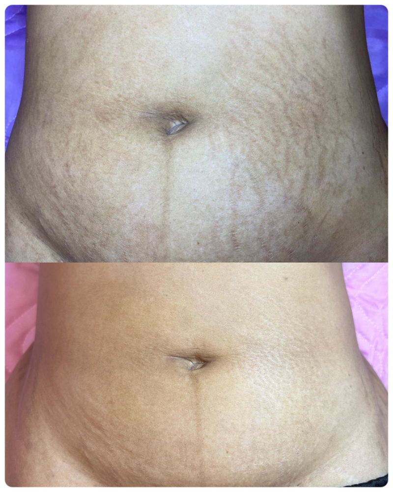 Inkless/Camo StretchM Lower Stomach