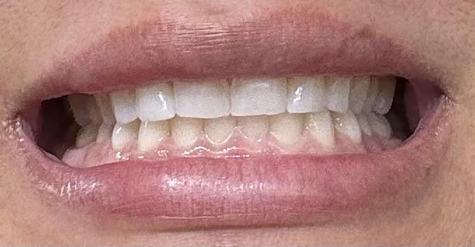 Cosmetic Mini Whitening