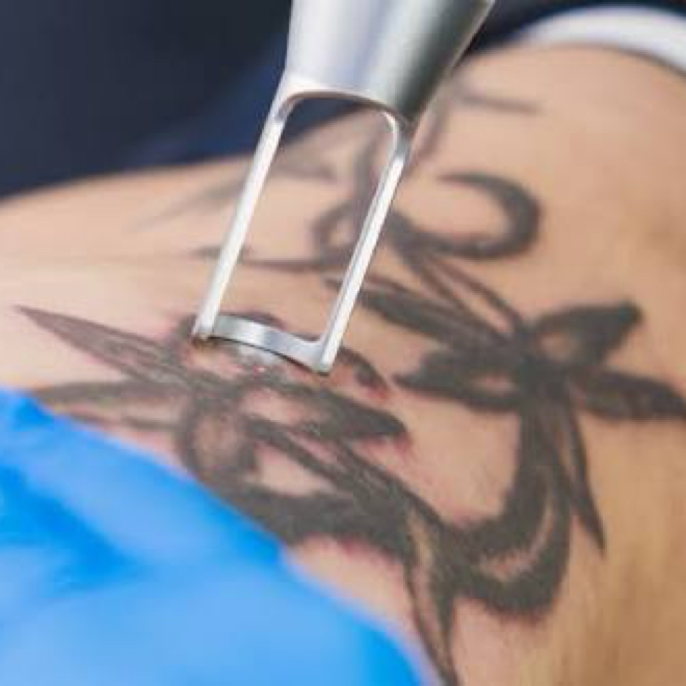 ✨Laser Tattoo Removal (1-2 Inches) at Nena’s Beauty Glow Bar in North Las Vegas, NV
