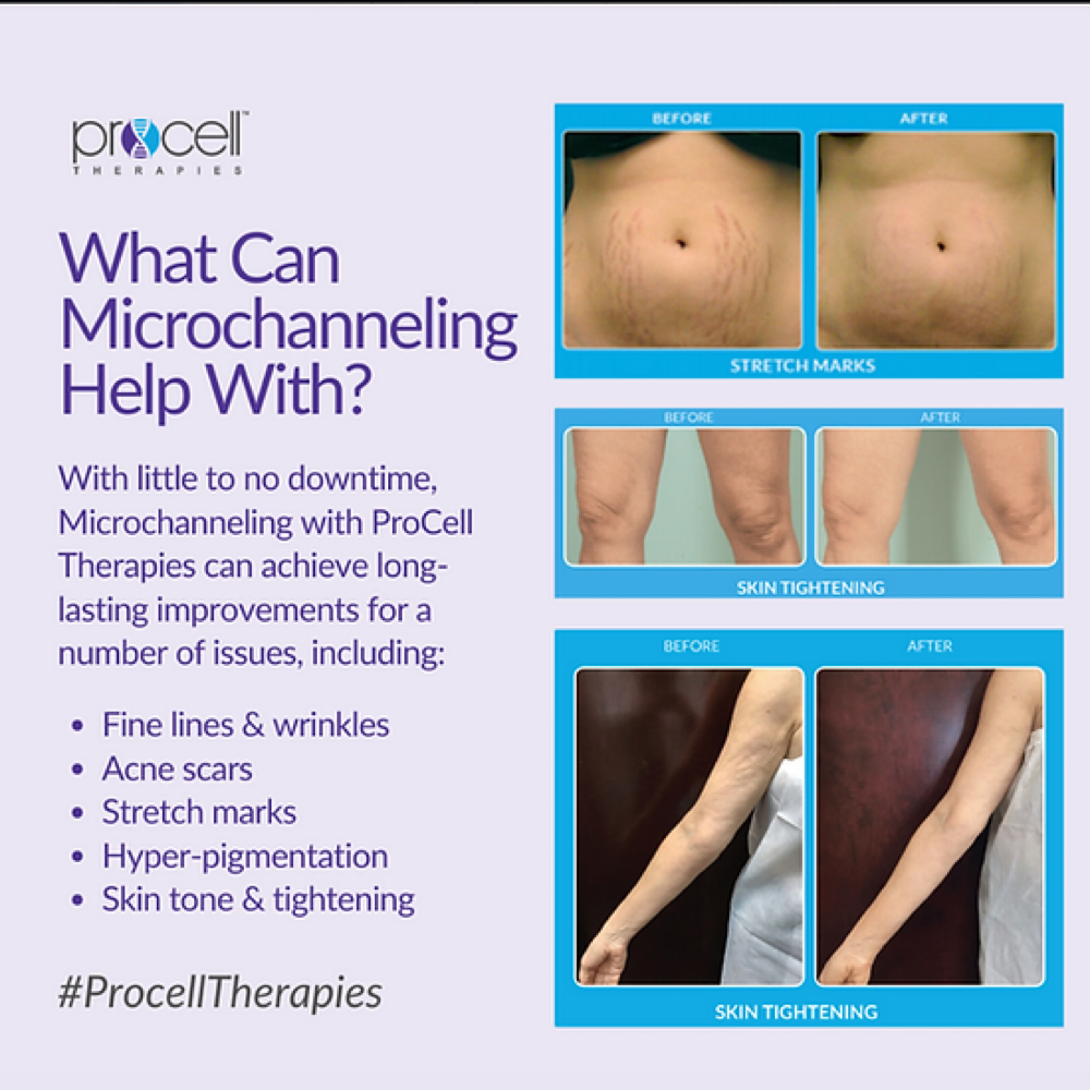 Procell Microchanneling- Body at Lumos Aesthetics & Wellness in Louisa, KY