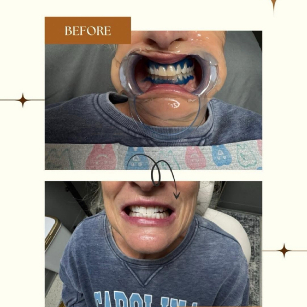 60 Min Whitening Service at ACE Smiles in Mayodan, NC