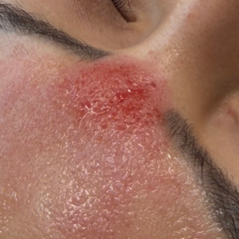 Microneedling at Lux Beauty Lounge in Alhambra, CA