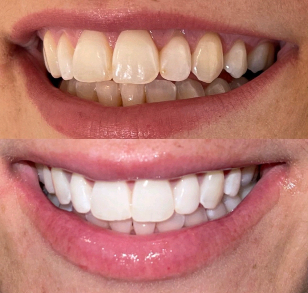 Teeth Whitening