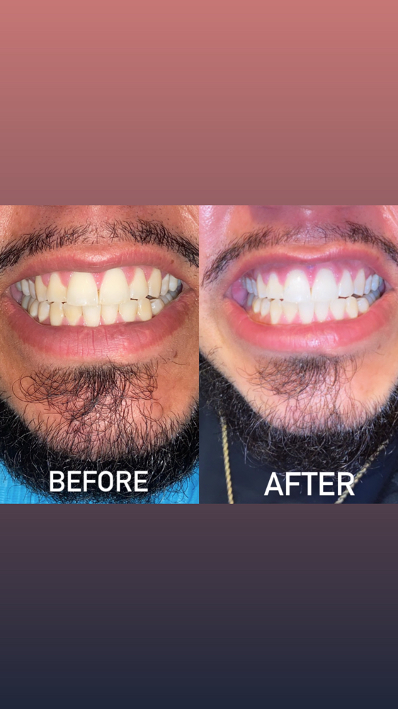 Teeth Whitening 30mins at Lashing_Expressions in Philadelphia, PA