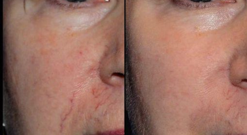 Capillary Treatment