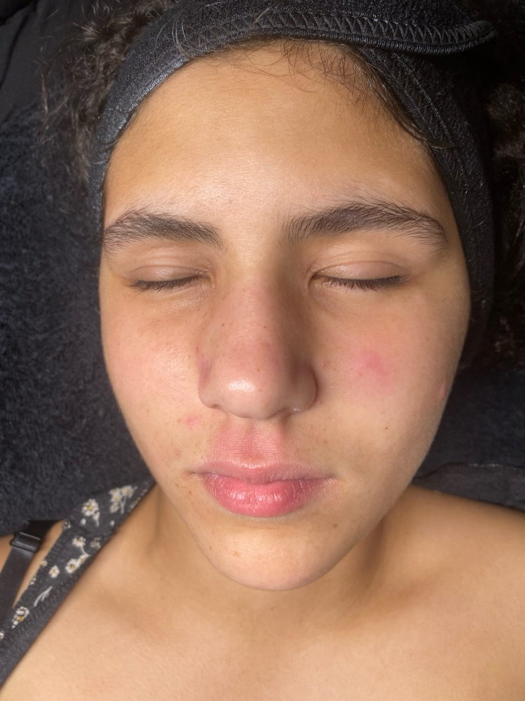 Teen Facial
