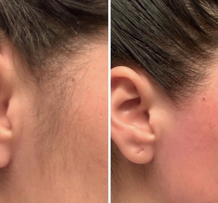 Waxing - Side-Burns