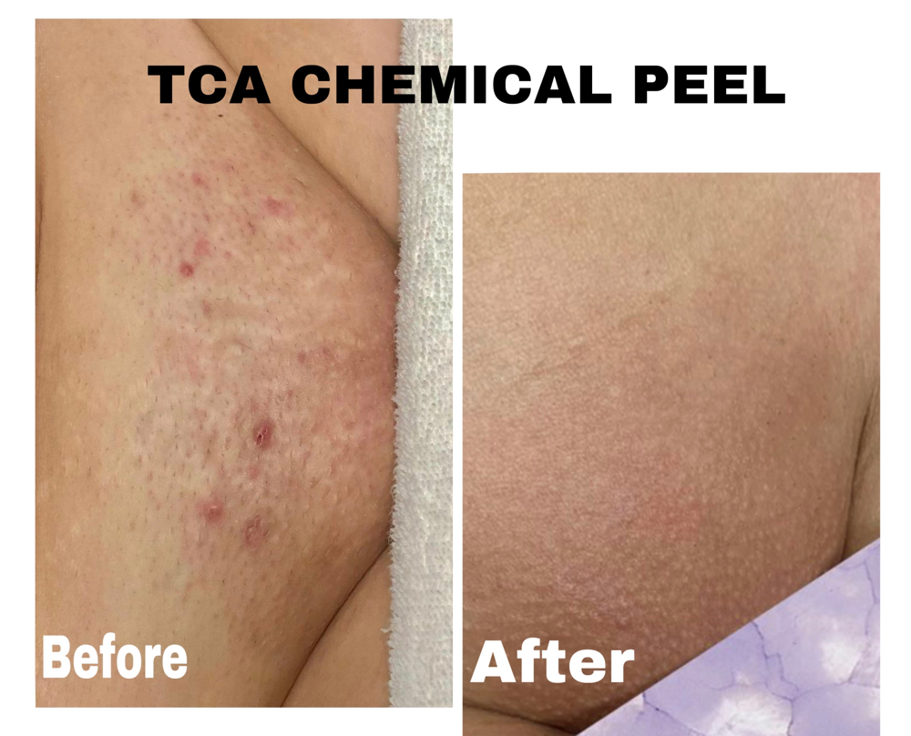 TCA Chemical Peel For Private Area