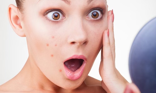 Acne Facial