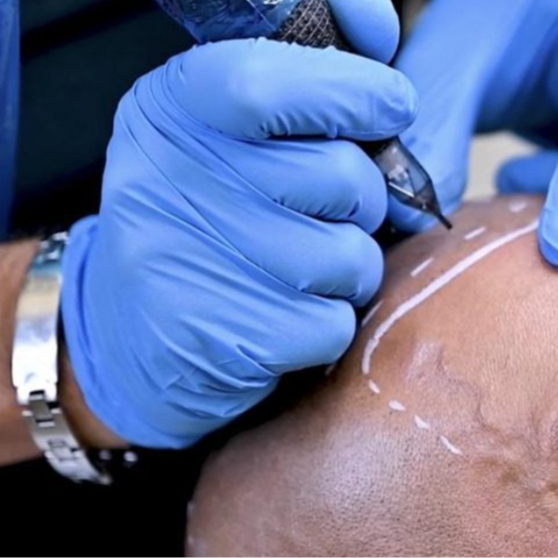 SCALP MICROPIGMENTATION (SMP) at Aurora Rose Beauty Spa in Fayetteville, NC