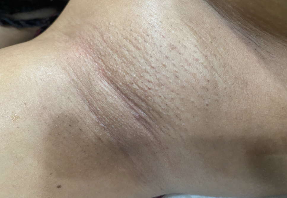 Underarm Wax