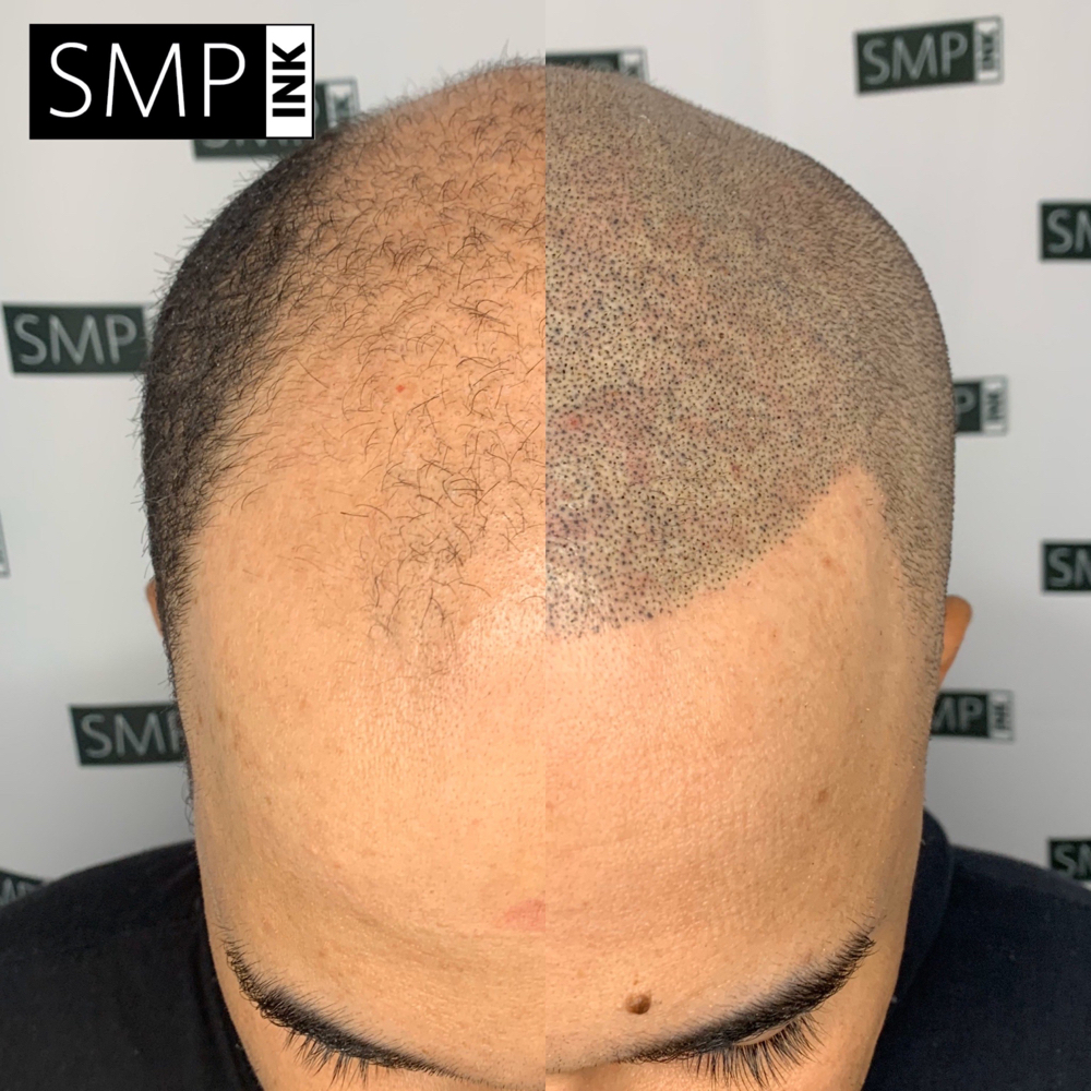 Scalp Micropogmentatiom