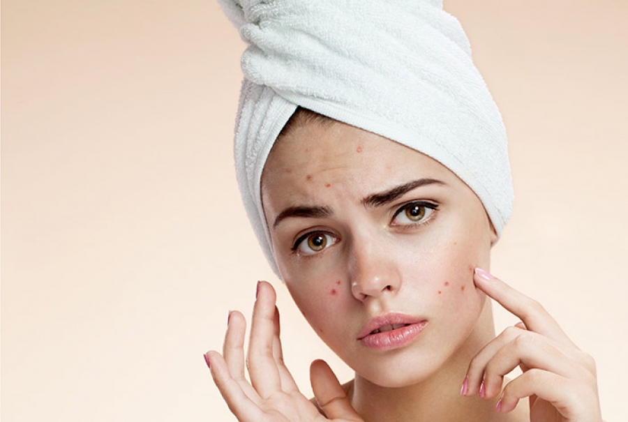 Acne Facial