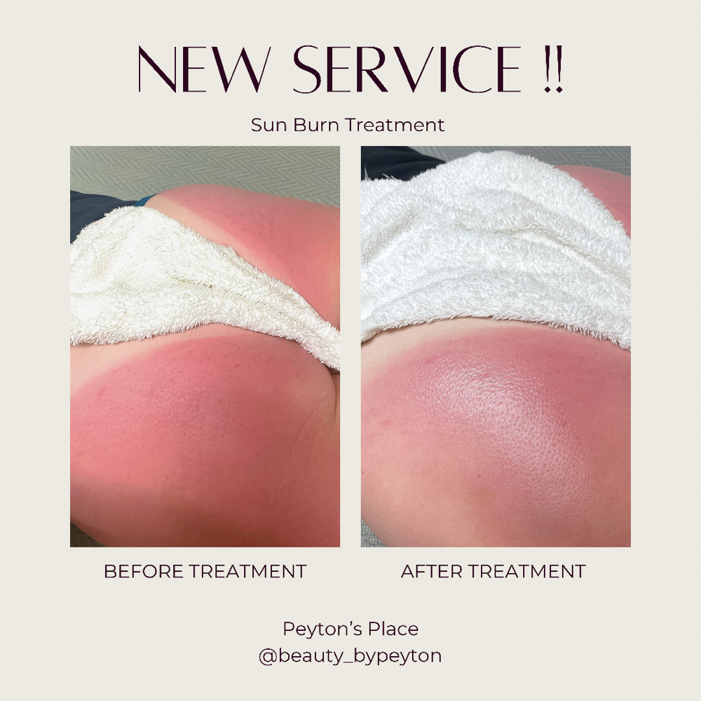Sun Burn Treatment
