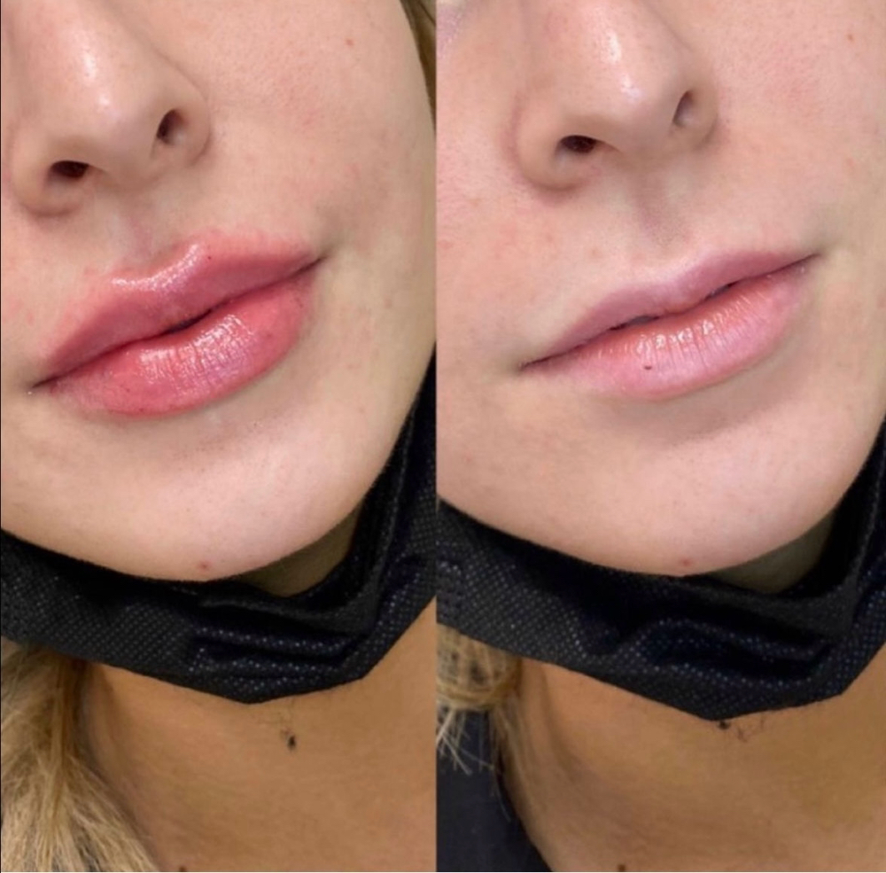 Hylauron Pen Lip Fillers