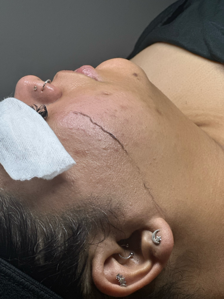 +Dermaplaning