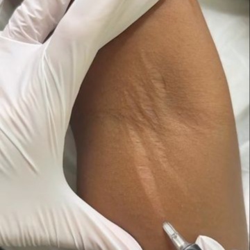 Small Scar bundle at Cosmetic Studio 54 in Los Angeles, CA