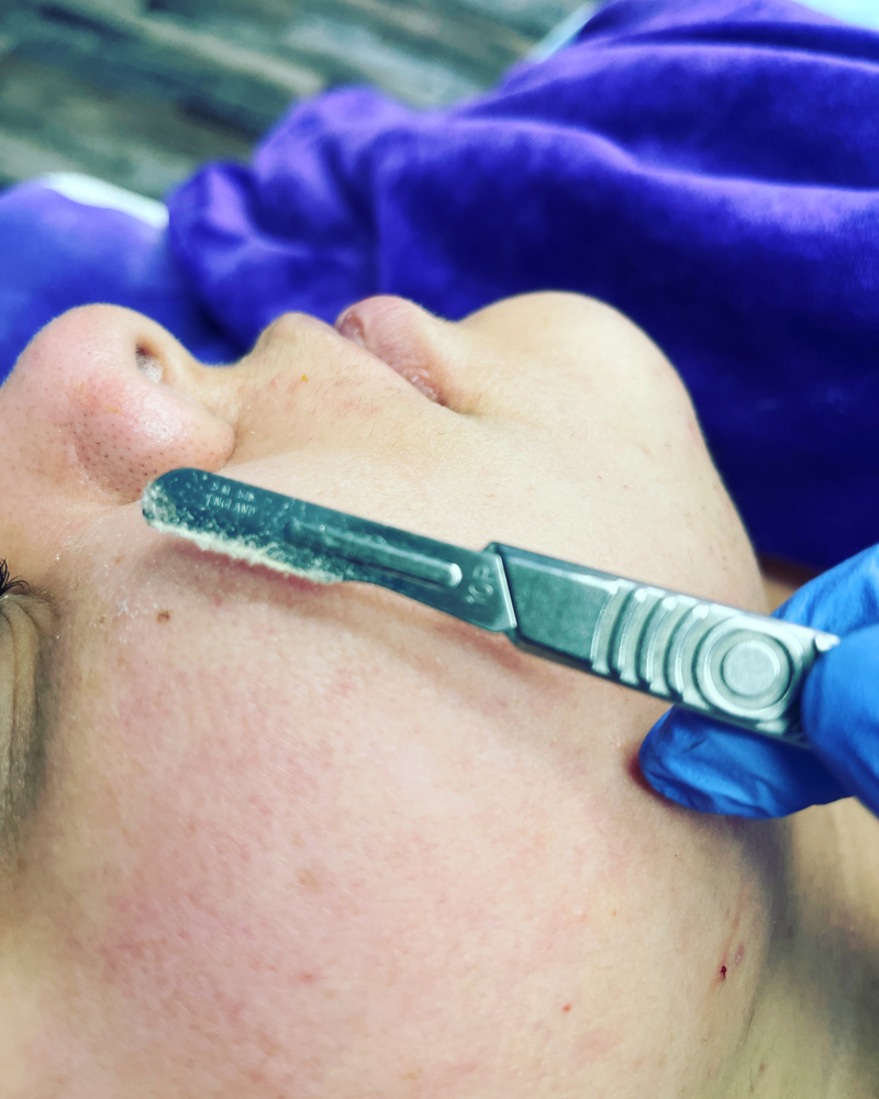 Dermaplaning