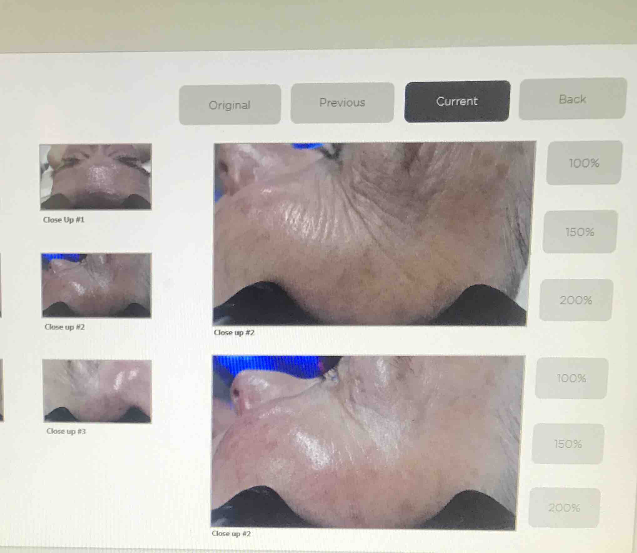 Dermaplane,Cryo-Face,Hydrafacial