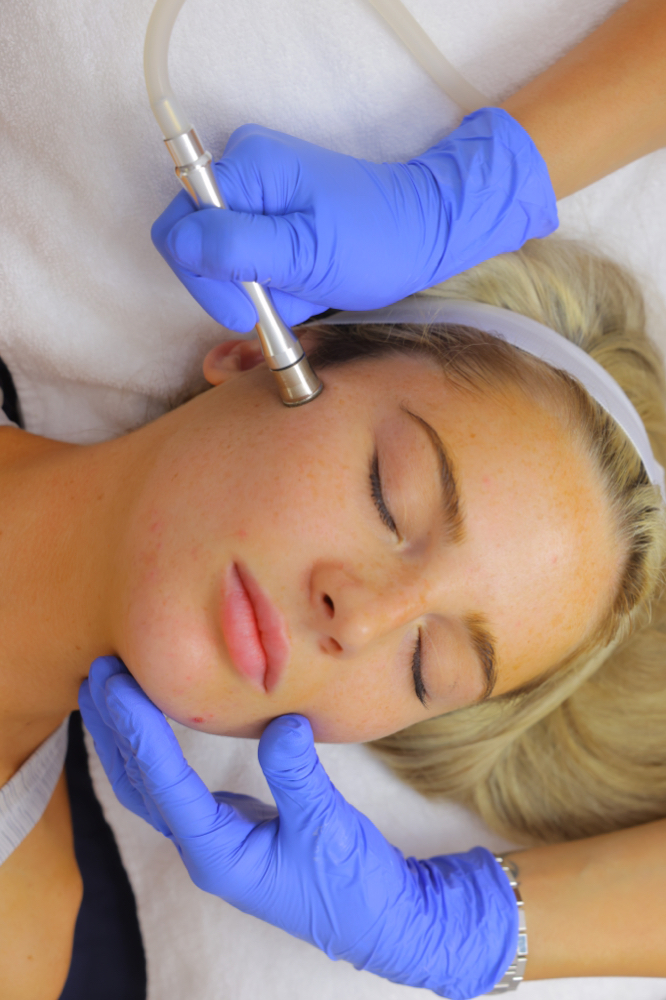 Microdermabrasion