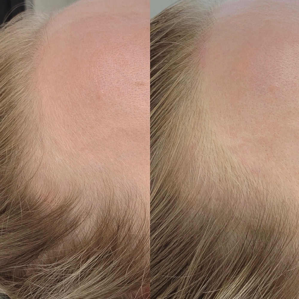 Scalp micropigmentation at Fluff & Ink in Tustin, CA