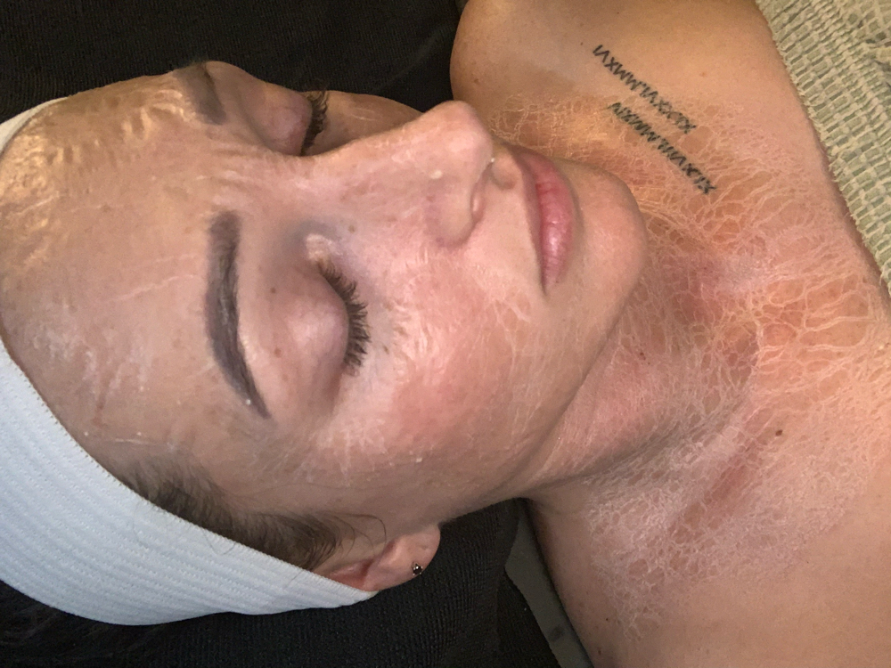 Protein Lift Oxygen Therapy