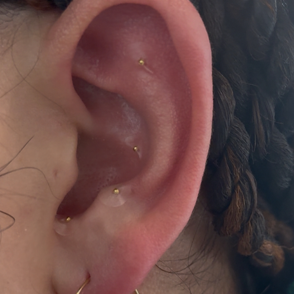 Ear seeding at Sage + Sea Esthetics in Sacramento, CA