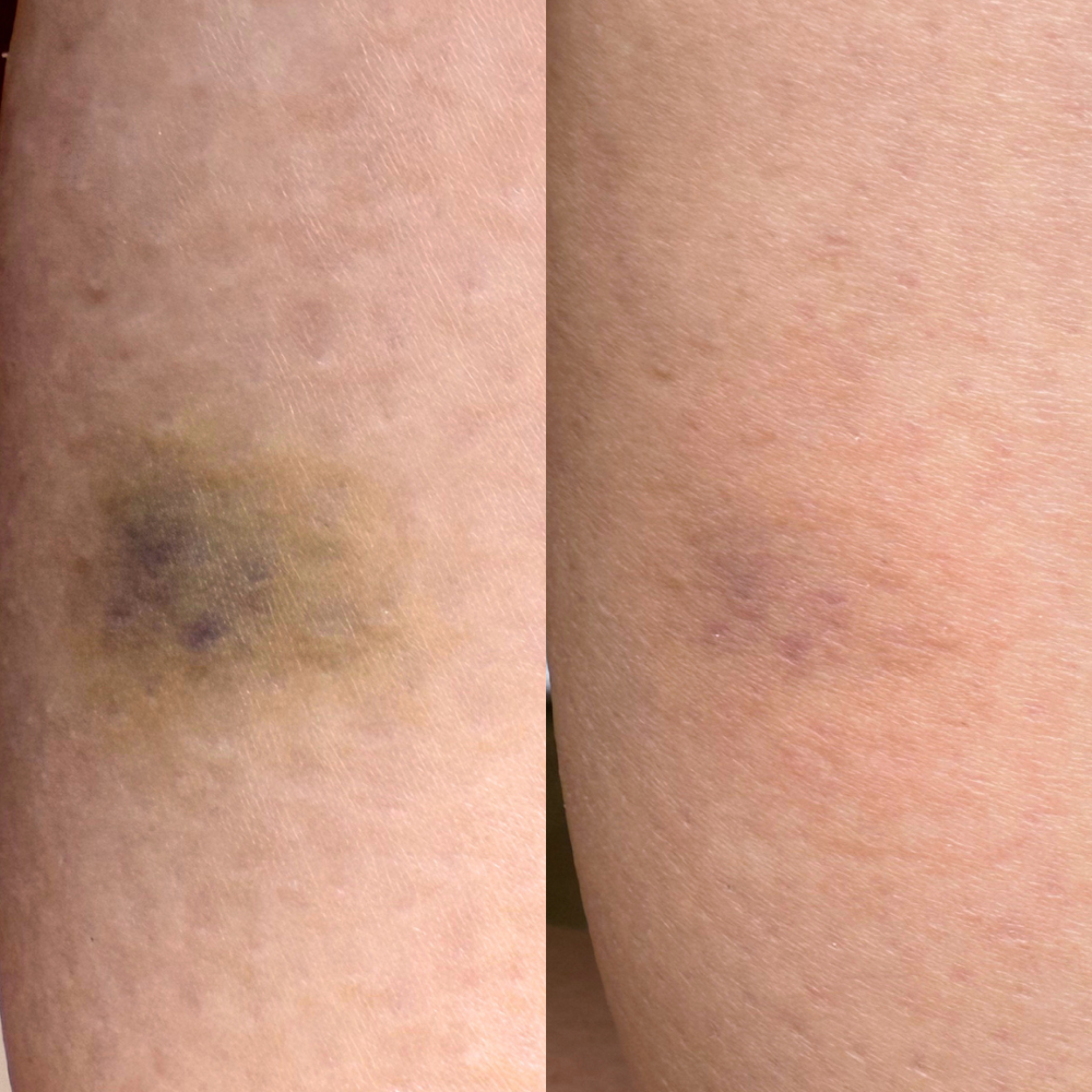 Bruise Treatment Add On