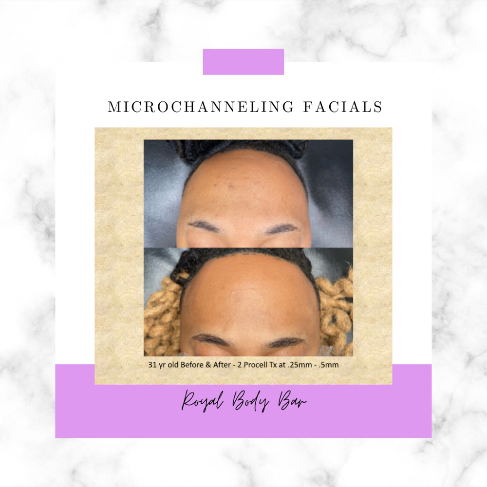 Microchanneling Facials (Face Only)