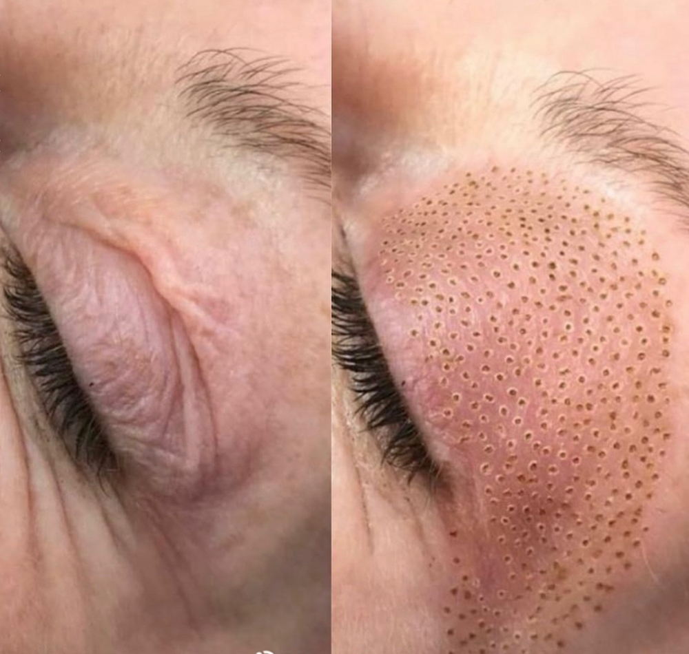 Plasma Pen Skin Tightening