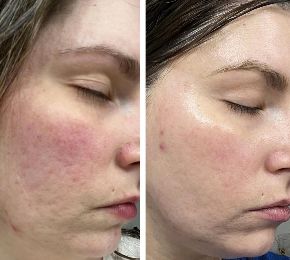 Virtual Skincare Consultation